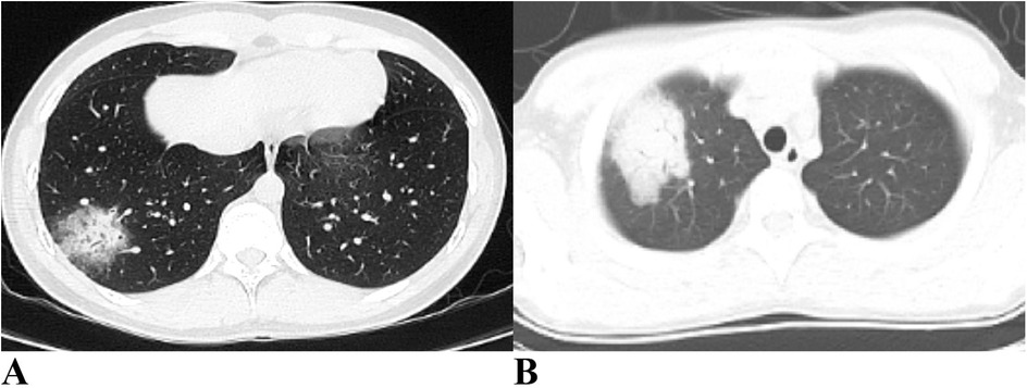 Panel A shows: Halo sign and air bronchogram sign are evident in the right lung. Panel B shows: Consolidation is observed in the right lung.