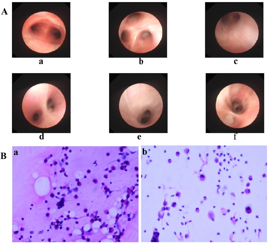 Series of medical images showing different clinical and microscopic views. A) Panels a to f depict endoscopic images of airways with varying visual characteristics. B) Microscopic images a and b show stained tissue samples with various cell densities and arrangements.