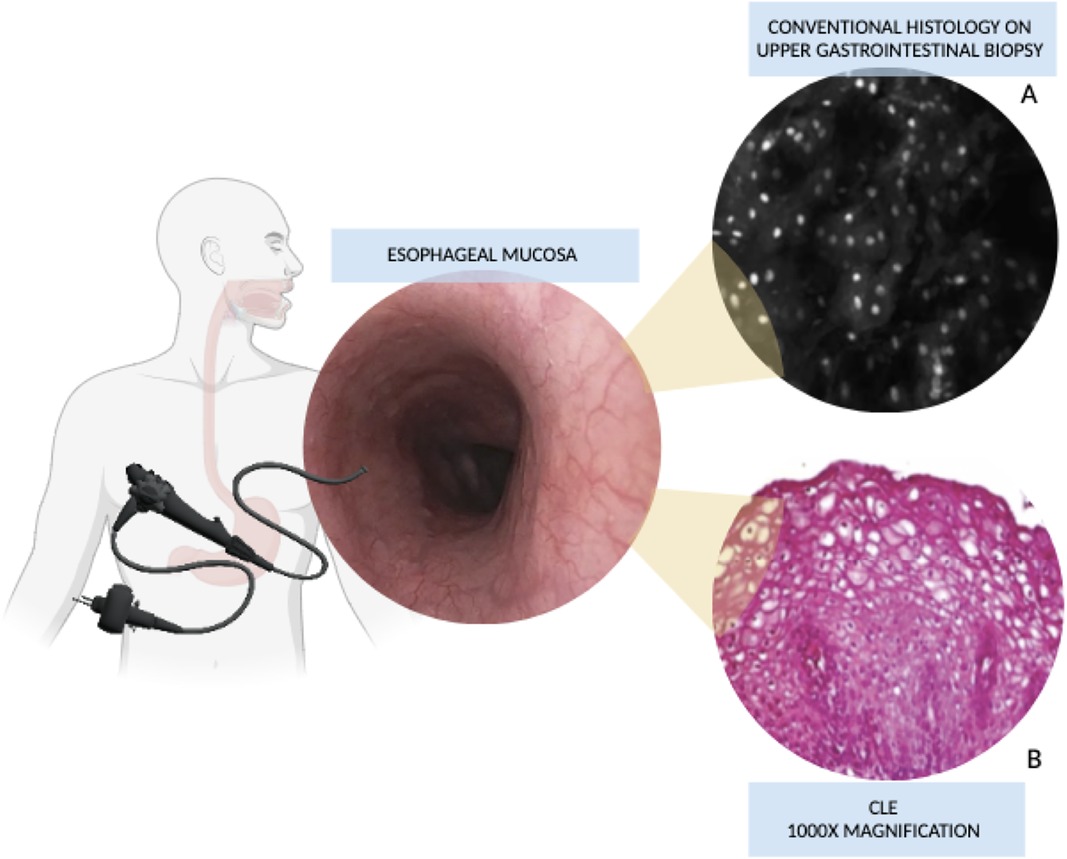 Esophageal mucosa image showing a diagram with an endoscope inserted down the throat for examination. Inset A displays conventional histology with a biopsy from the upper gastrointestinal tract. Inset B shows a confocal laser endomicroscopy (CLE) image at 1000x magnification.