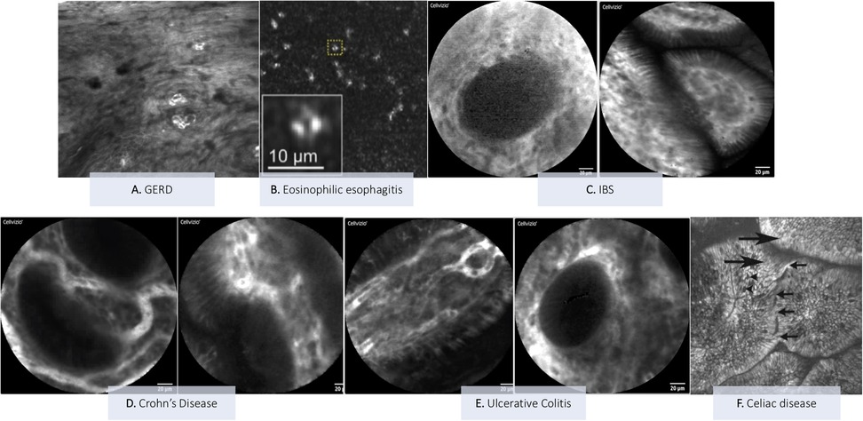 Microscopic images of six gastrointestinal conditions. A: Gastroesophageal reflux disease (GERD) shows uneven textures. B: Eosinophilic esophagitis features scattered bright spots. C: IBS displays circular patterns. D: Crohn’s Disease shows irregular shapes. E: Ulcerative colitis highlights elongated structures. F: Celiac disease is marked with arrows indicating structural details.