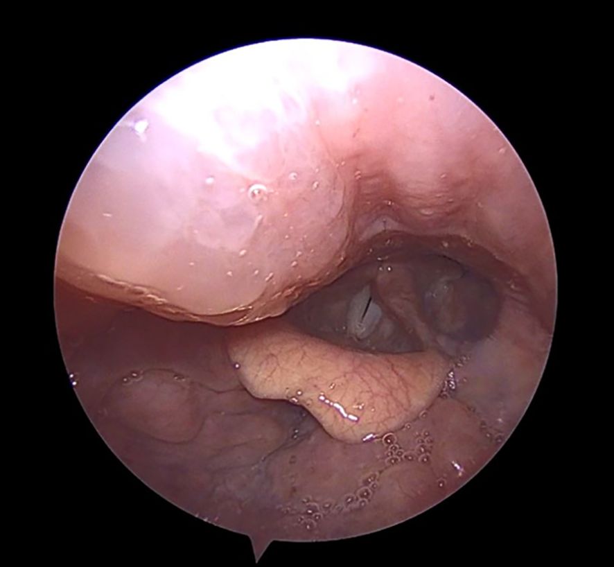 Endoscopic view of the esophagus, showing pink tissue with ridges. Some mucus and small bubbles are visible on the surface, indicating internal bodily structures.