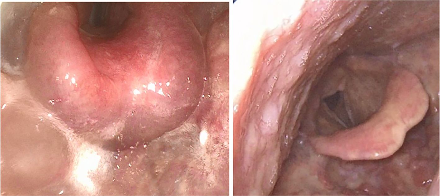 Close-up endoscopic images showing a section of the gastrointestinal tract. The left image displays a swollen, reddish area with some reflection of light, suggesting inflammation or swelling. The right image shows a more tubular structure with a visible fold, possibly indicating a different segment of the tract.