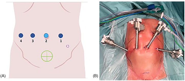 Diagram on the left shows four numbered incision points on an abdomen for a laparoscopic robot assisted procedure. Image on the right displays a patient's abdomen with surgical instruments inserted through incisions, demonstrating the ports in use during surgery.
