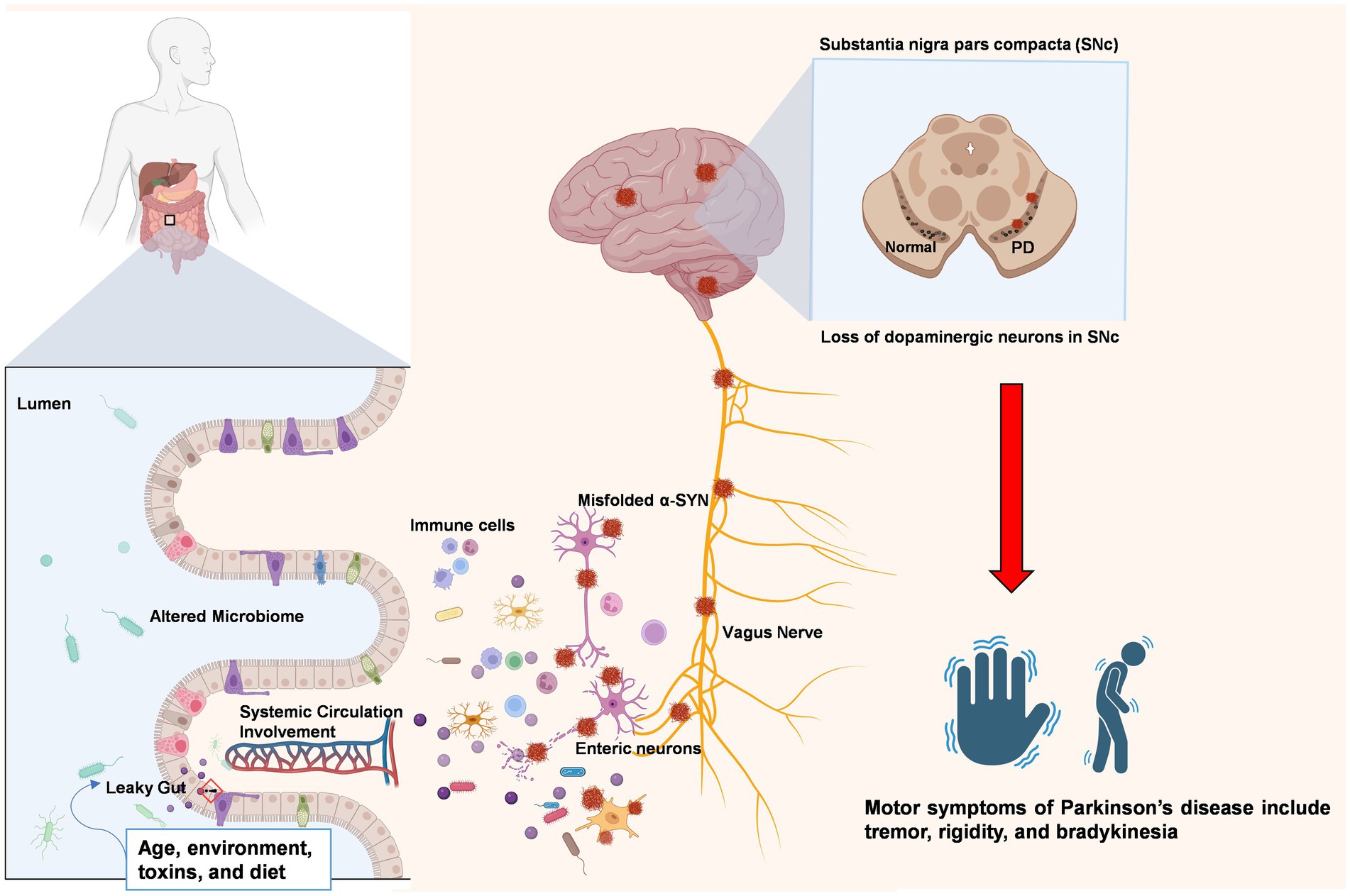 Diagram illustrating the connection between gut health and Parkinson’s disease. It shows a leaky gut, systemic circulation involvement, and altered microbiome leading to the misfolding of α-SYN proteins. These proteins travel via the vagus nerve to the brain, particularly impacting the substantia nigra pars compacta (SNc), causing loss of dopaminergic neurons. This results in motor symptoms like tremor, rigidity, and bradykinesia. Factors such as age, environment, toxins, and diet contribute to these changes.