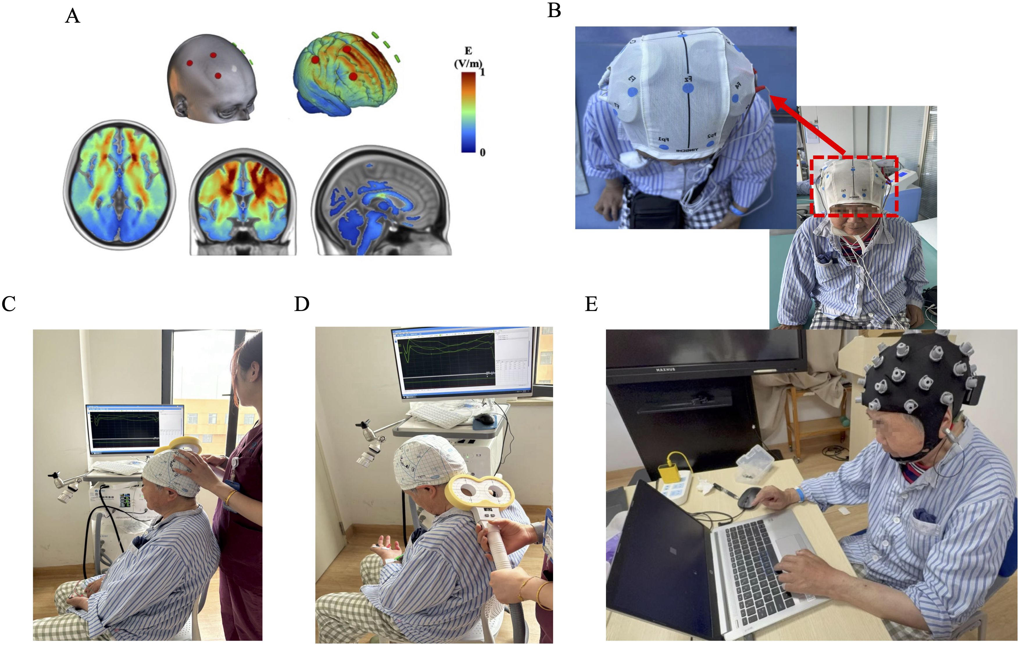 A: Illustrations of brain imaging showing electrical stimulation points and brain activity maps. B: A person wearing a cap with electrodes for brain monitoring, highlighted by a red square. C: Medical professional performing a procedure on a seated person with a electrode cap, using equipment connected to a computer displaying graphs. D: Similar to C, showing a close-up of equipment application on the person’s head with graphs on the screen. E: Individual using a laptop while wearing a sensor cap, connected to devices on the table.