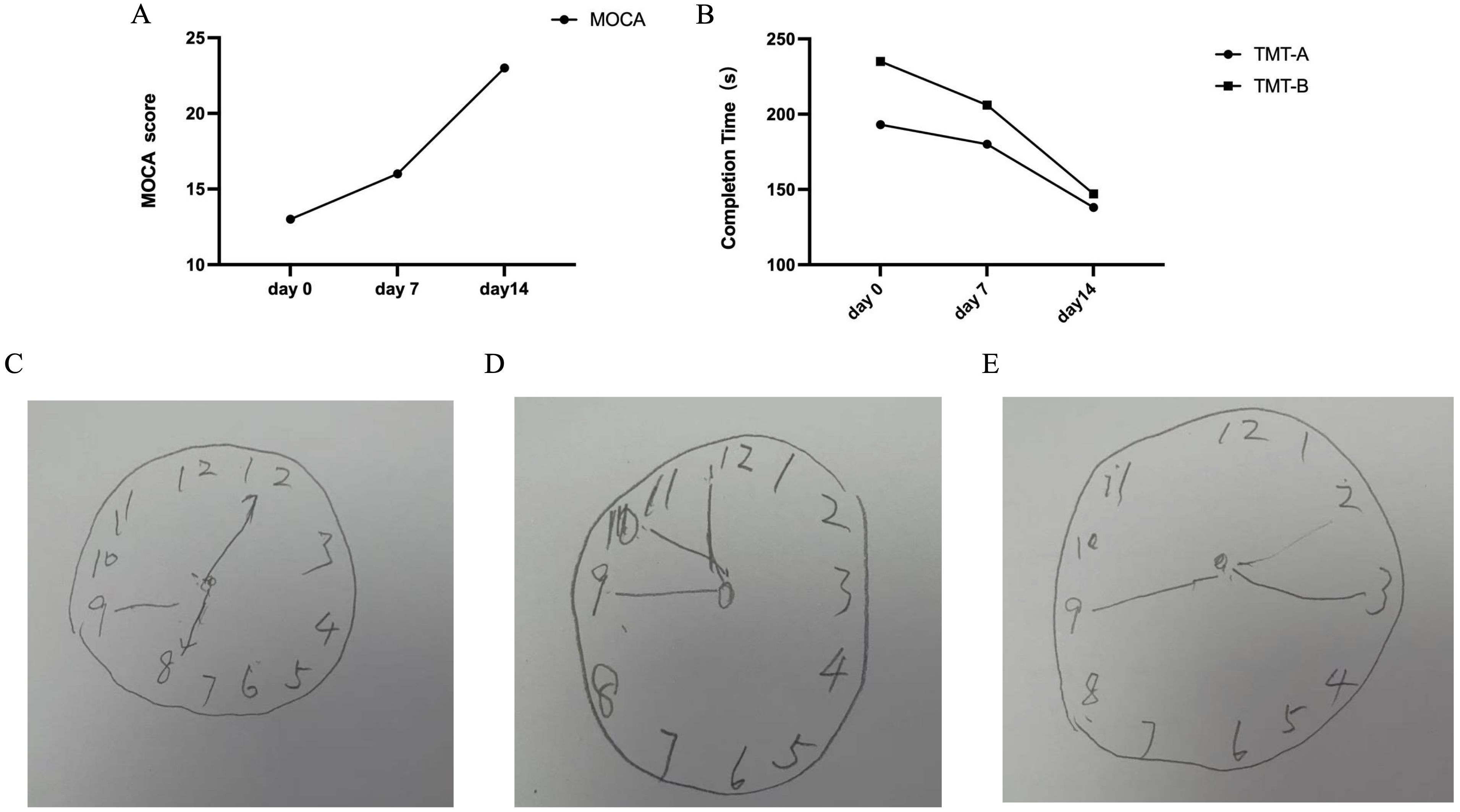 A series of images displaying cognitive assessment results. Image A: Line graph showing an increase in MOCA scores from day 0 to day 14. Image B: Line graph showing a decrease in TMT-A and TMT-B completion times over the same period. Images C, D, and E: Drawings of clocks with different times, demonstrating a cognitive clock-drawing task. The times and placements of numbers vary.