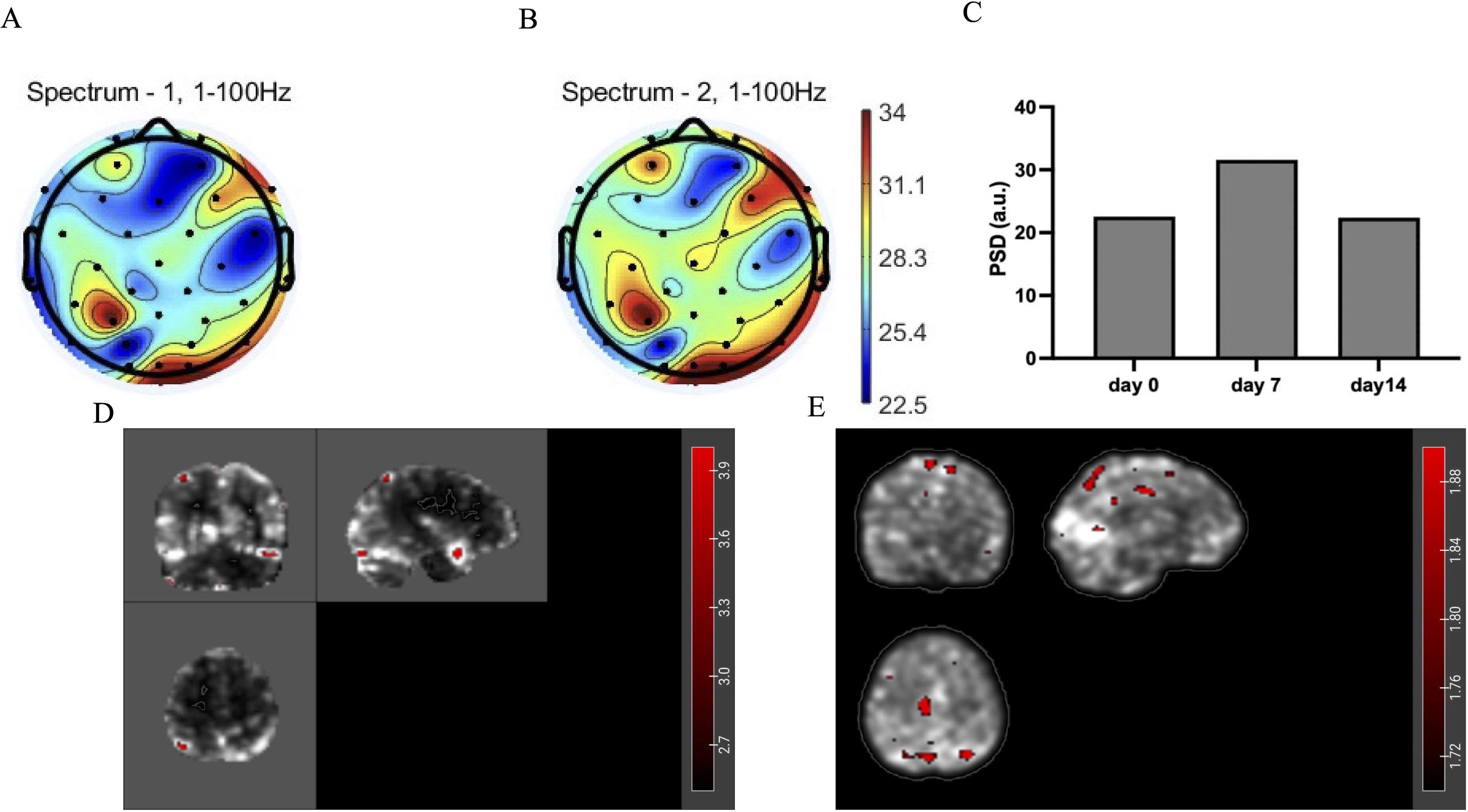 Topographic brain maps and data visualizations are shown. Figures A and B display topographic maps for two frequency spectra ranging from one to one hundred hertz, with color gradients indicating power distribution. Figure C is a bar graph showing Power Spectral Density (PSD) in arbitrary units over three time points: day zero, day seven, and day fourteen. Figures D and E present brain scans with highlighted areas in red, demonstrating variations in neural activity; D and E use a gray and red color scale and a red gradient indicating activity intensity.