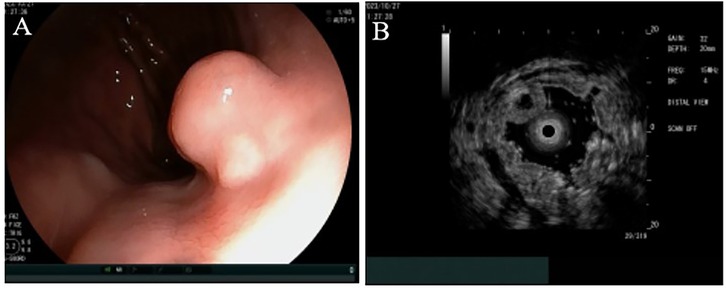 Panel A shows an endoscopic image of the gastrointestinal tract with a smooth, rounded mass visible. Panel B displays an ultrasound image with concentric circular patterns surrounding a dark central area, likely illustrating internal anatomical features.