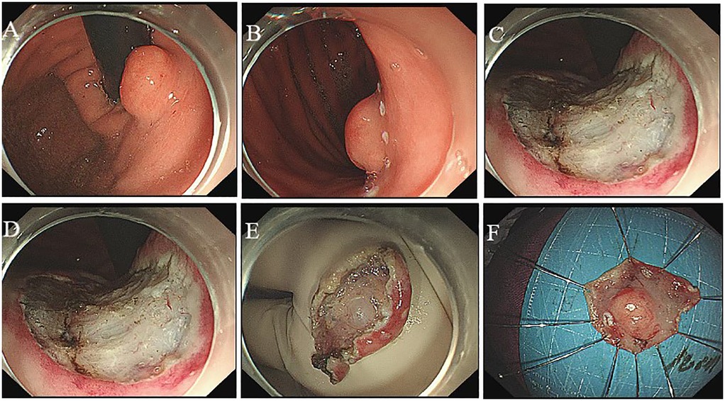 Endoscopic images showing stages of a medical procedure: A and B depict the initial state of a polyp in the colon; C and D show the polyp being removed; E displays the extracted polyp; F reveals the polyp on a blue surgical mat.