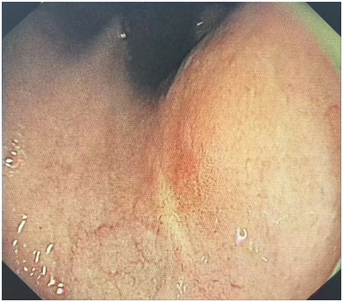 Endoscopic image showing the internal view of a gastrointestinal tract. The surface appears smooth and slightly reddish, with visible vascular patterns and some fluid droplets.