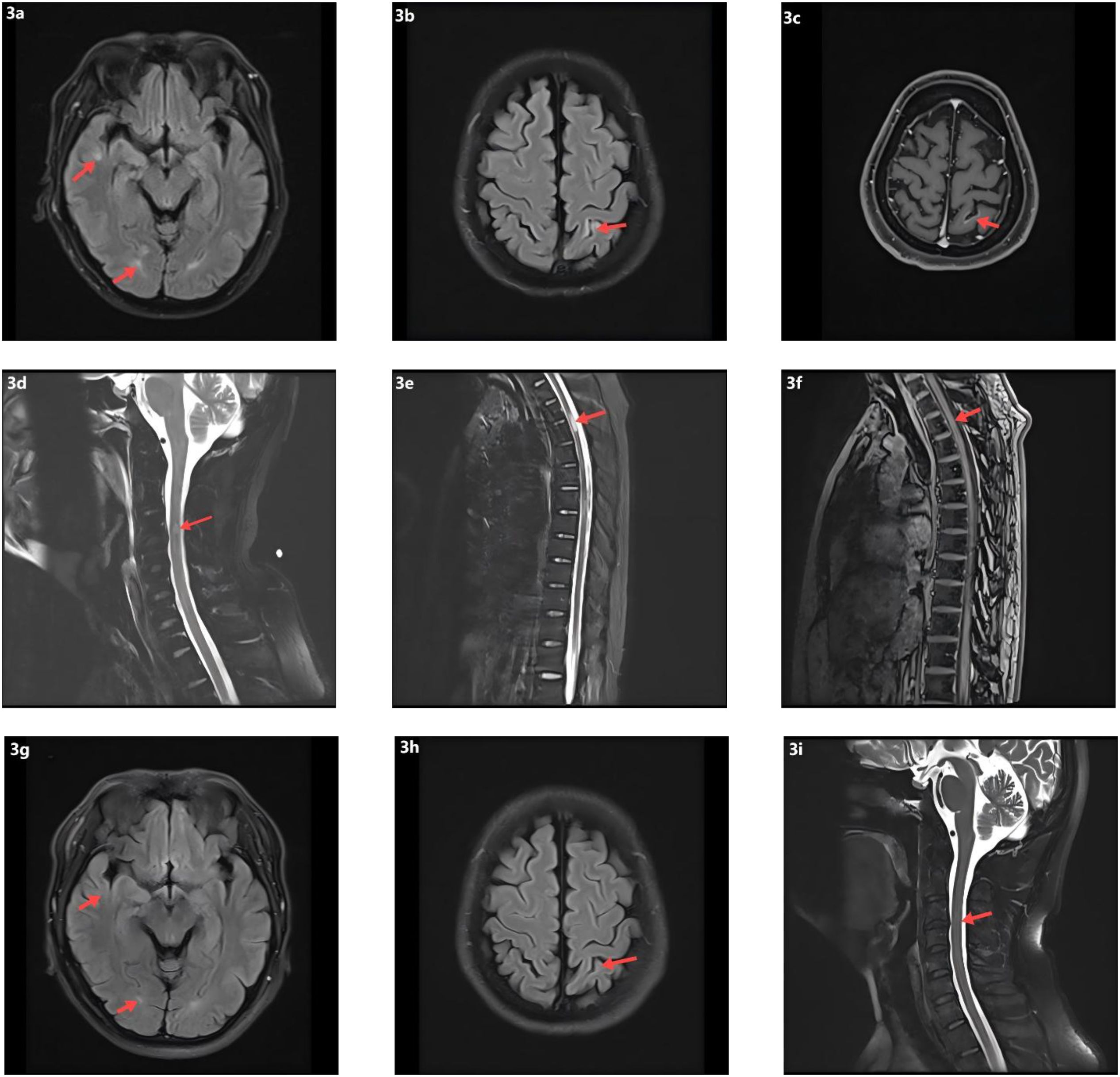 Nine MRI scans labeled 3a to 3i show different views of the brain and spinal cord with red arrows indicating areas of interest. Scans 3a, 3b, 3c, 3g, and 3h highlight regions in the brain. Scans 3d, 3e, 3f, and 3i focus on the spinal cord, indicating specific points along the vertebrae. The arrows suggest abnormalities or areas needing further examination.