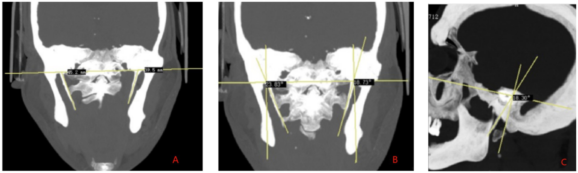 CT scan images labeled A, B, and C show measurements and angles of the coronoid process in different views. A displays the length of the bilateral coronoid processes. B shows medial declination angle of 23.83 and 18.73 degrees. C shows an anterior inclination angle of 18.30 degrees. The yellow lines indicate reference lines on the black background.