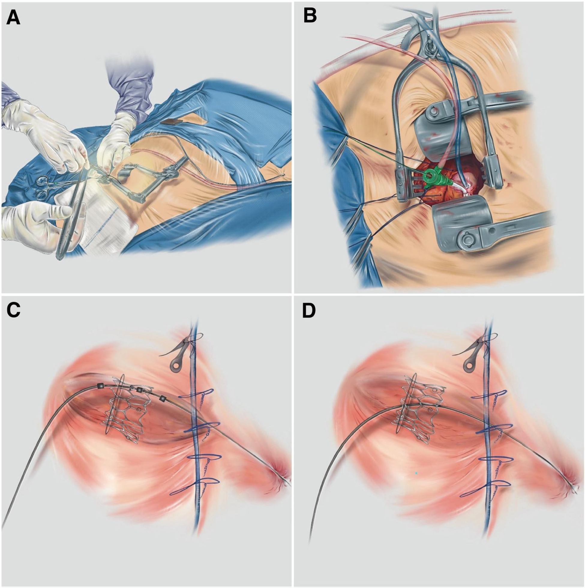 Illustration showing a four-panel surgical procedure sequence. Panel A depicts a surgeon making an incision on a patient's side. Panel B shows a close-up of surgical instruments and open tissue exposing internal organs. Panels C and D illustrate the positioning of medical devices inside the body, attached to the spine and secured with sutures and plates.