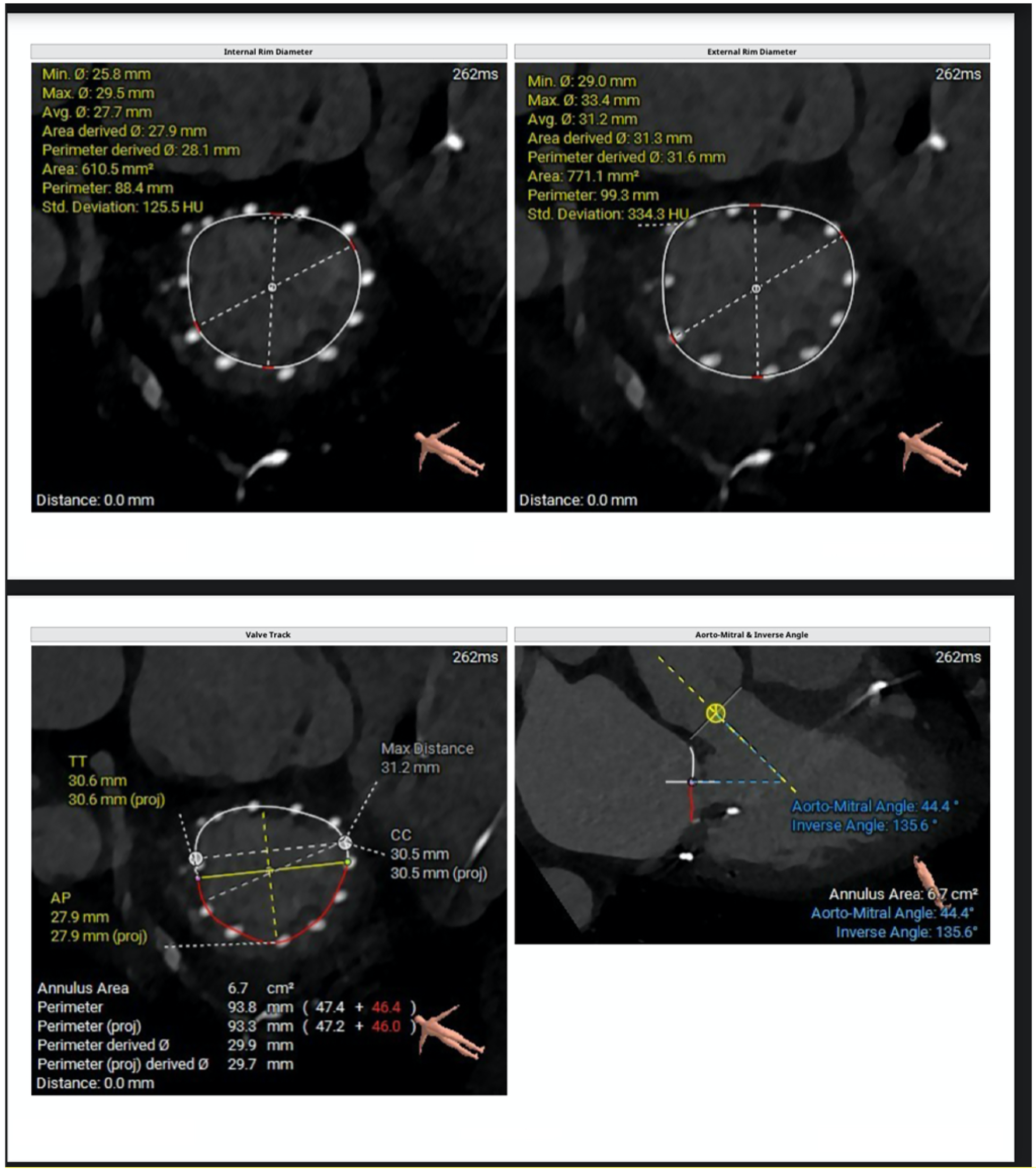 Medical imaging analysis showing measurements and calculations of internal and external rim diameters, valve track, and aorto-mitral angles. Top left displays internal rim diameter with dimensions in millimeters and highlight in white. Top right shows external rim with similar data. Bottom left illustrates the valve track with various measurements and calculations. Bottom right features aorto-mitral angles and inverse angles with detailed annotations.
