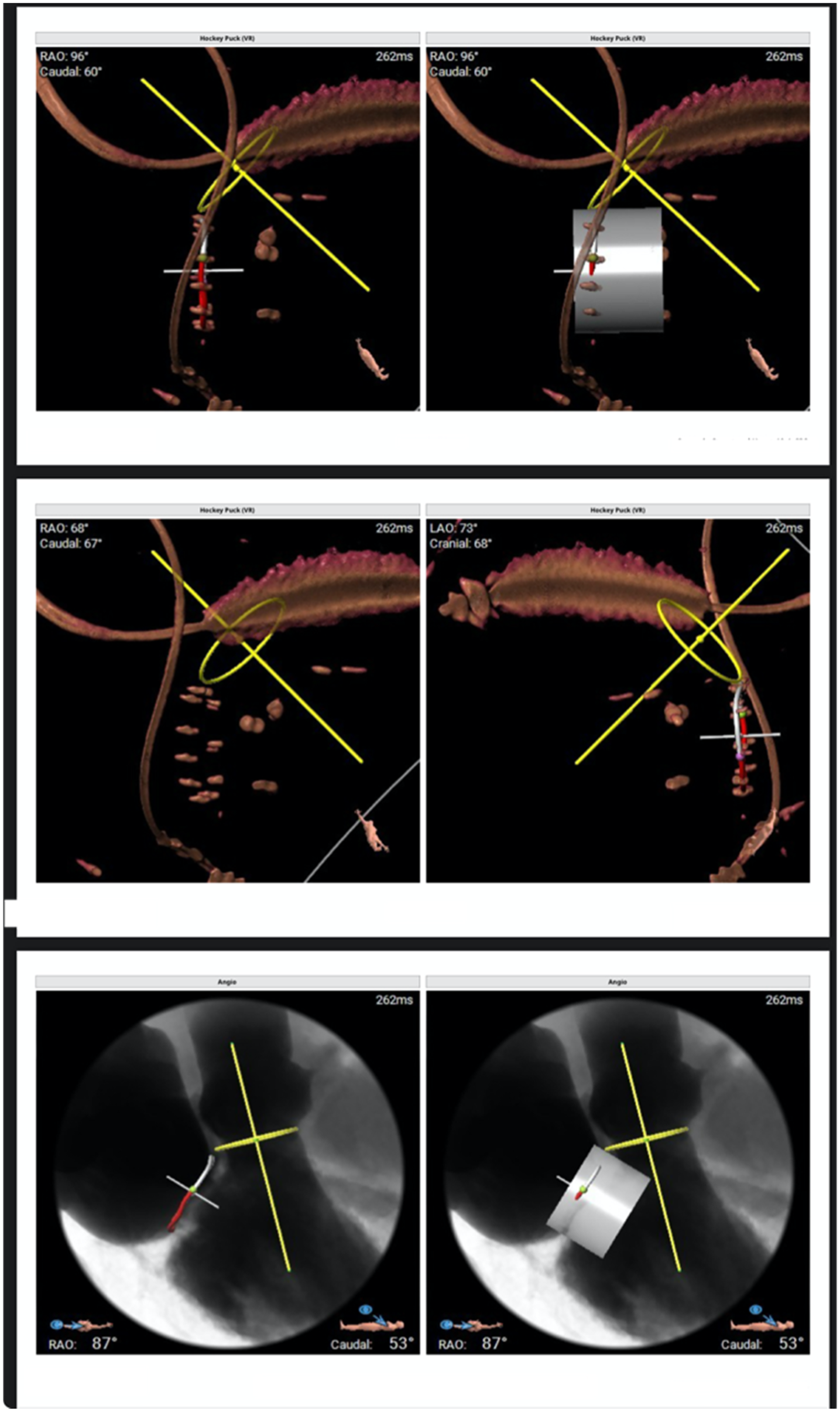 Medical imaging showing four panels with 3D coronary artery views and X-ray images. Each panel has yellow lines indicating angles and measurements, with tags like RAO, LAO, cranial, and caudal. Top panels depict 3D models with highlighted areas, while bottom panels show grayscale X-ray images with similar markings.