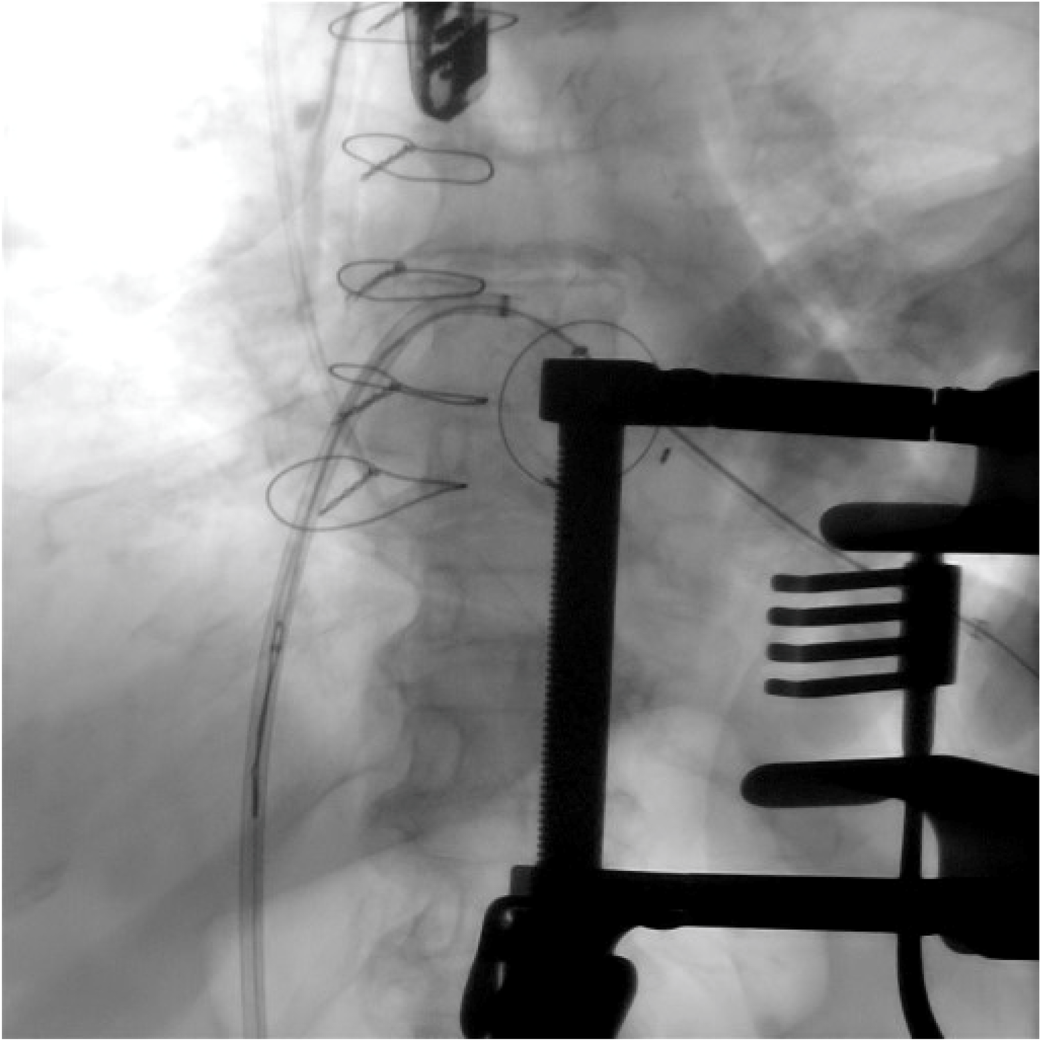 X-ray image showing a spinal procedure involving metal instrumentation. Several loops of wire and a tool with prongs are visible near the spine, suggesting surgical intervention.