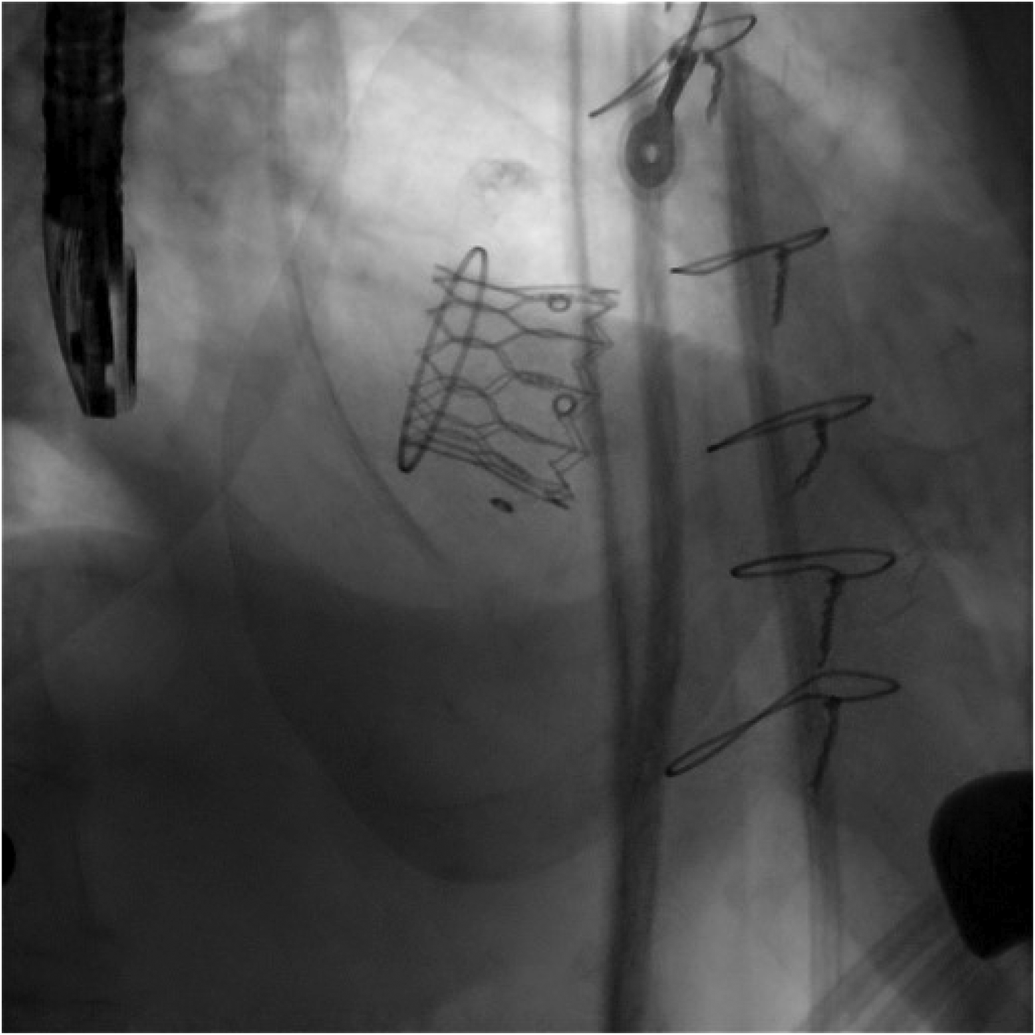 X-ray image showing a stent placed in a blood vessel, with several surgical clips visible alongside the vessel. The stent is an expandable mesh structure.