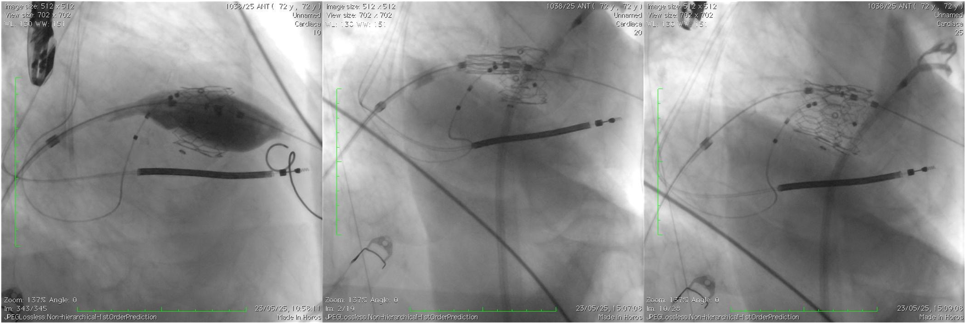 Three X-ray images of a cardiac procedure showing the implantation of a medical device. The images display wires and a stent-like structure inside the body, highlighting different stages and angles of the procedure.