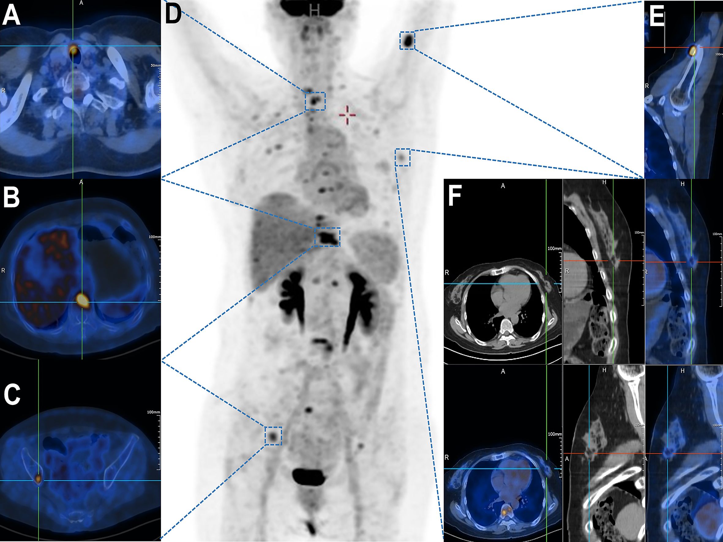 Composite of medical imaging scans displaying various perspectives. Panel A shows a PET/CT scan of the abdomen cross-section highlighting metabolic activity. Panel B displays a PET/CT scan of a thoracic cross-section. Panel C shows a PET/CT scan of the pelvic region. Panel D depicts a full-body scan with focus points marked. Panel E highlights the sagittal view of a specific region. Panel F is a series of cross-sectional, sagittal, and coronal images of the chest, showcasing anatomical structures and metabolic regions.