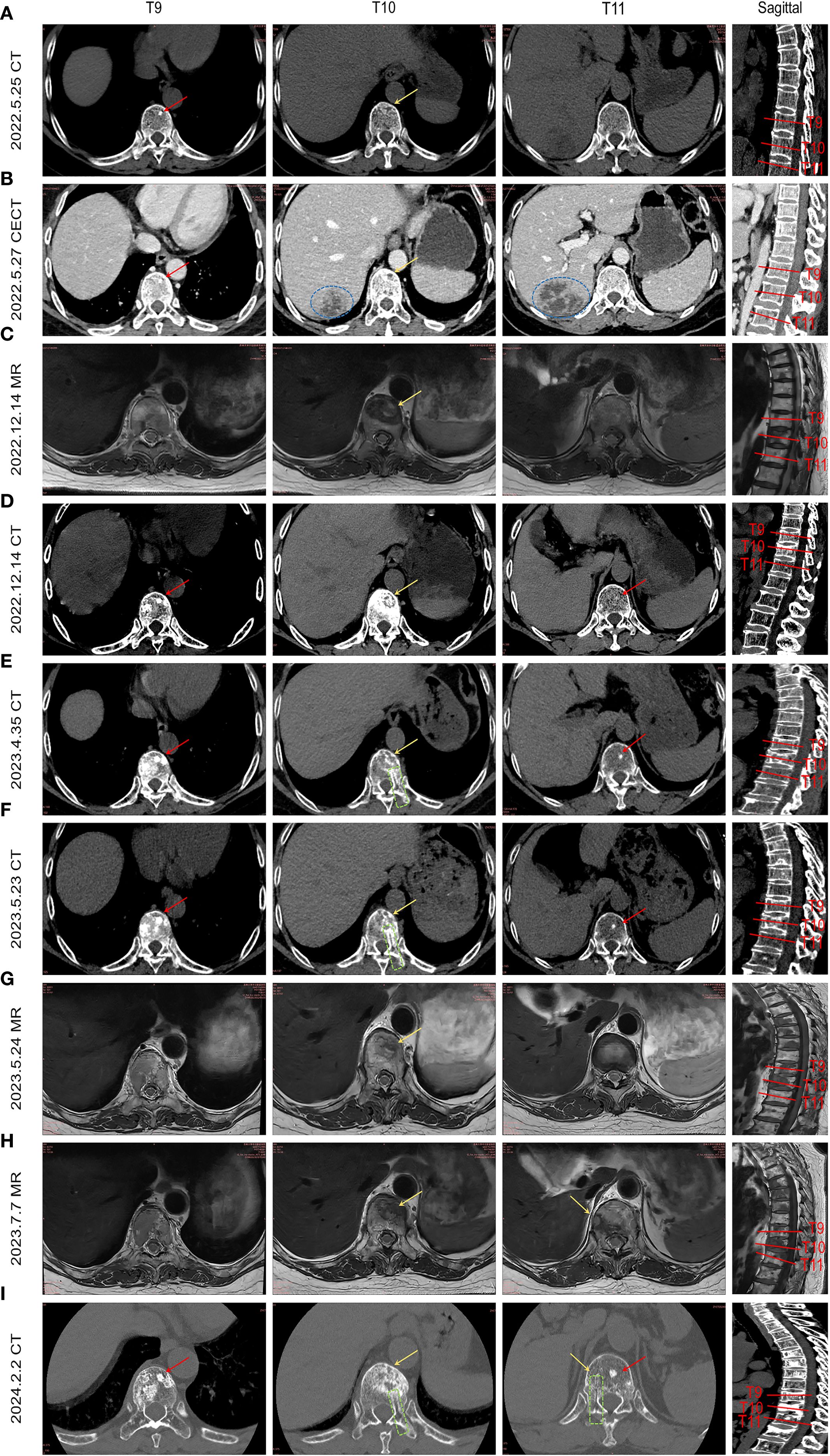 Medical imaging sequence showing multiple cross-sectional CT and MR scans of thoracic vertebrae T9 to T11 in axial and sagittal views. Each row represents different dates ranging from 2022 to 2024, with arrows indicating specific areas of focus on the vertebrae. Red and yellow markers highlight potential abnormalities or areas of interest, with some scans annotated in blue or green. The sagittal views on the right provide a complete side view of the thoracic spine segment, with vertebrae labeled.
