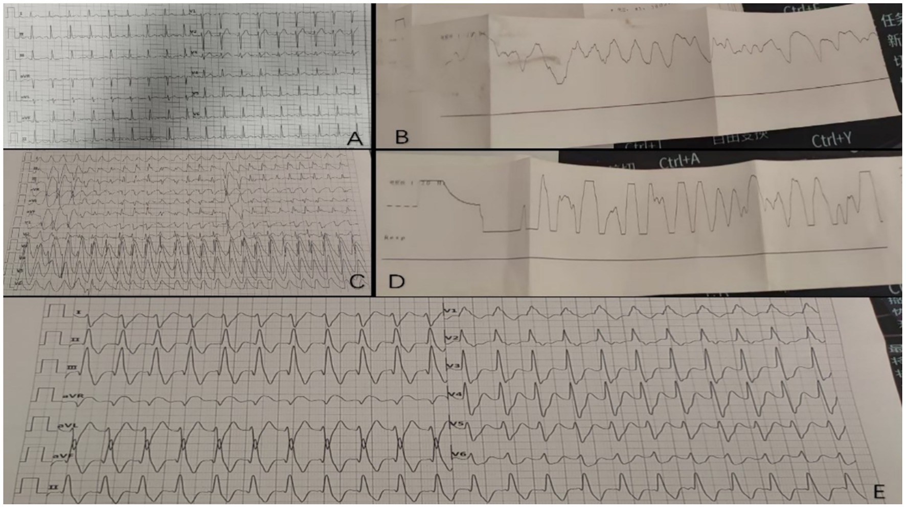 Several panels of printed medical waveforms are displayed. Panel A shows a standard electrocardiogram (ECG) with consistent peaks and troughs. Panels B and D feature neatly folded paper with irregular waveforms, possibly representing respiratory or other physiological data. Panels C and E focus on ECGs with more pronounced and sharper waves, indicating detailed heart rhythm data. Each panel highlights different aspects or conditions of heart and physiological activity.