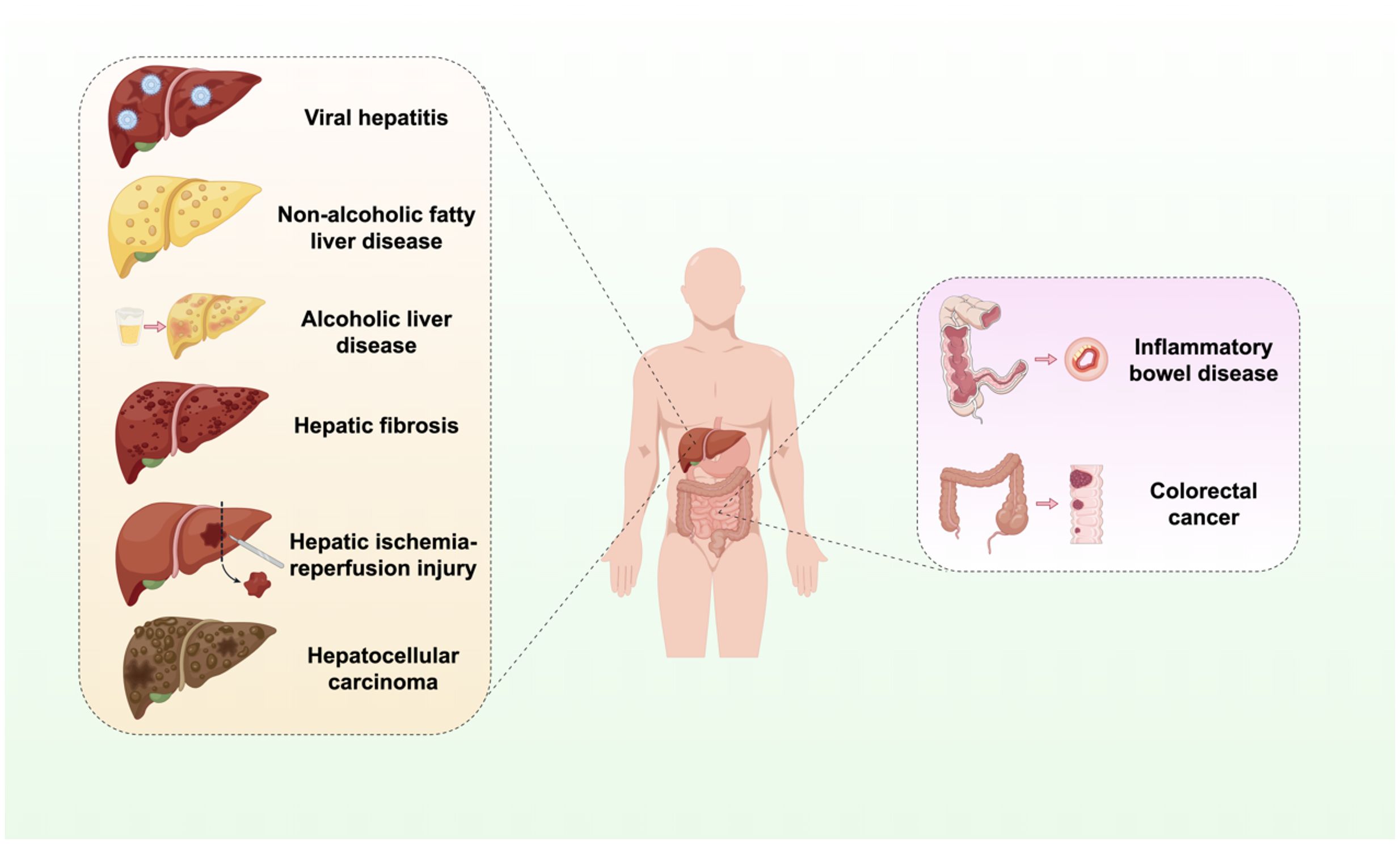 Diagram showing liver and bowel diseases affecting the human body. The liver conditions include viral hepatitis, non-alcoholic fatty liver disease, alcoholic liver disease, hepatic fibrosis, hepatic ischemia-reperfusion injury, and hepatocellular carcinoma. The bowel conditions depicted are inflammatory bowel disease and colorectal cancer. Sections highlight the affected organs: liver on the left and bowel on the right, connected to a human figure in the center.