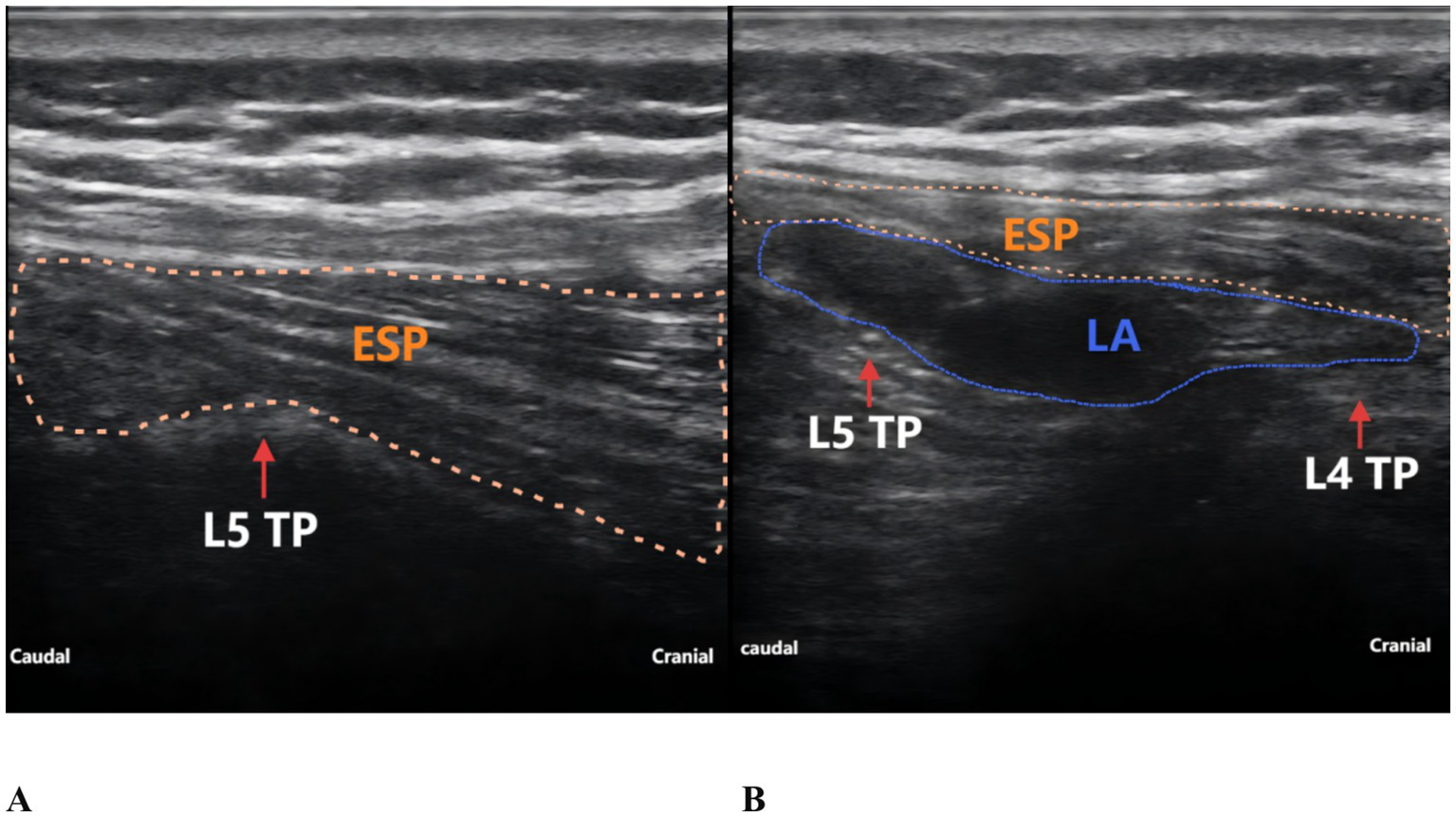 Ultrasound images of the lumbar region showing the Erector Spinae Plane (ESP) and transverse processes (TP) of L4 and L5 vertebrae. Panel A highlights the ESP region above L5 TP, outlined in orange. Panel B shows the LA (Local Anesthetic) area, highlighted in blue, between L4 and L5 TP. Cranial and caudal directions are labeled.