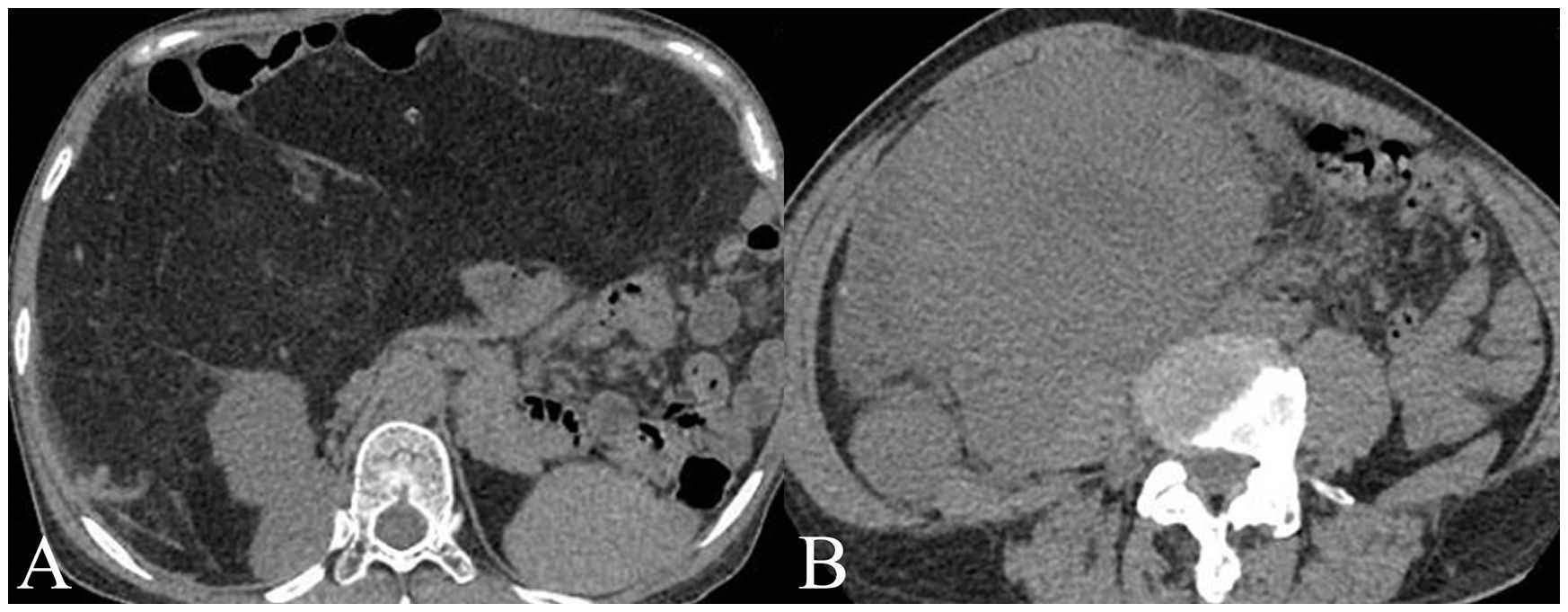 CT scans labeled A and B show sections of the abdomen. Image A displays a transverse section with visible vertebrae and gas pockets, while image B shows a sagittal section with distinct soft tissue densities and contrast-enhanced areas.