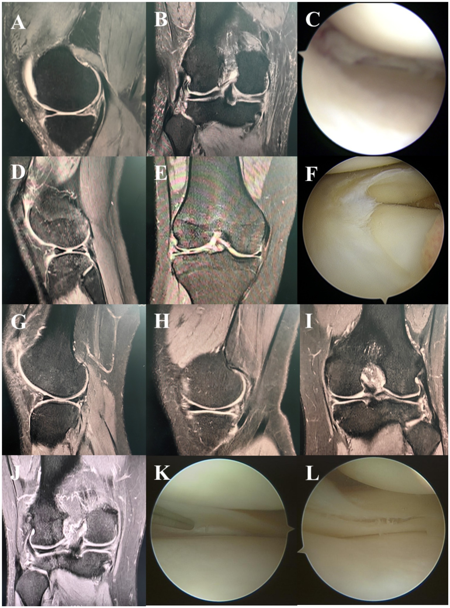 MRI and arthroscopic images of knees labeled A to L. Images A, B, D, E, G, H, I, and J depict various angles and conditions of knee joints, showing meniscal tears and cartilage conditions. Images C, F, K, and L are arthroscopic views inside the knee, illustrating the surface and internal conditions of the meniscus and cartilage.