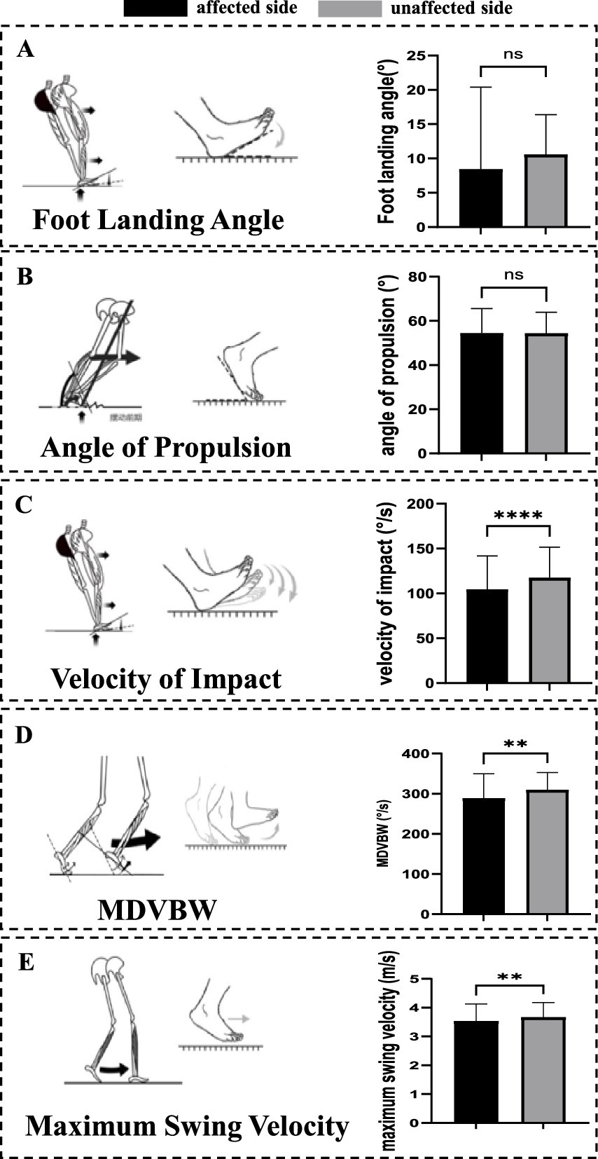Data visualization with five panels comparing affected and unaffected side metrics in a study. Panel A shows foot landing angle, with a bar chart indicating no significant difference. Panel B presents angle of propulsion, also showing no significant difference. Panel C depicts velocity of impact, with a significant increase on the affected side. Panel D illustrates mean dynamic vertical body weight (MDVBW), with a moderate increase on the affected side. Panel E highlights maximum swing velocity, showing a significant increase on the affected side. Each panel includes an illustration and corresponding bar chart.