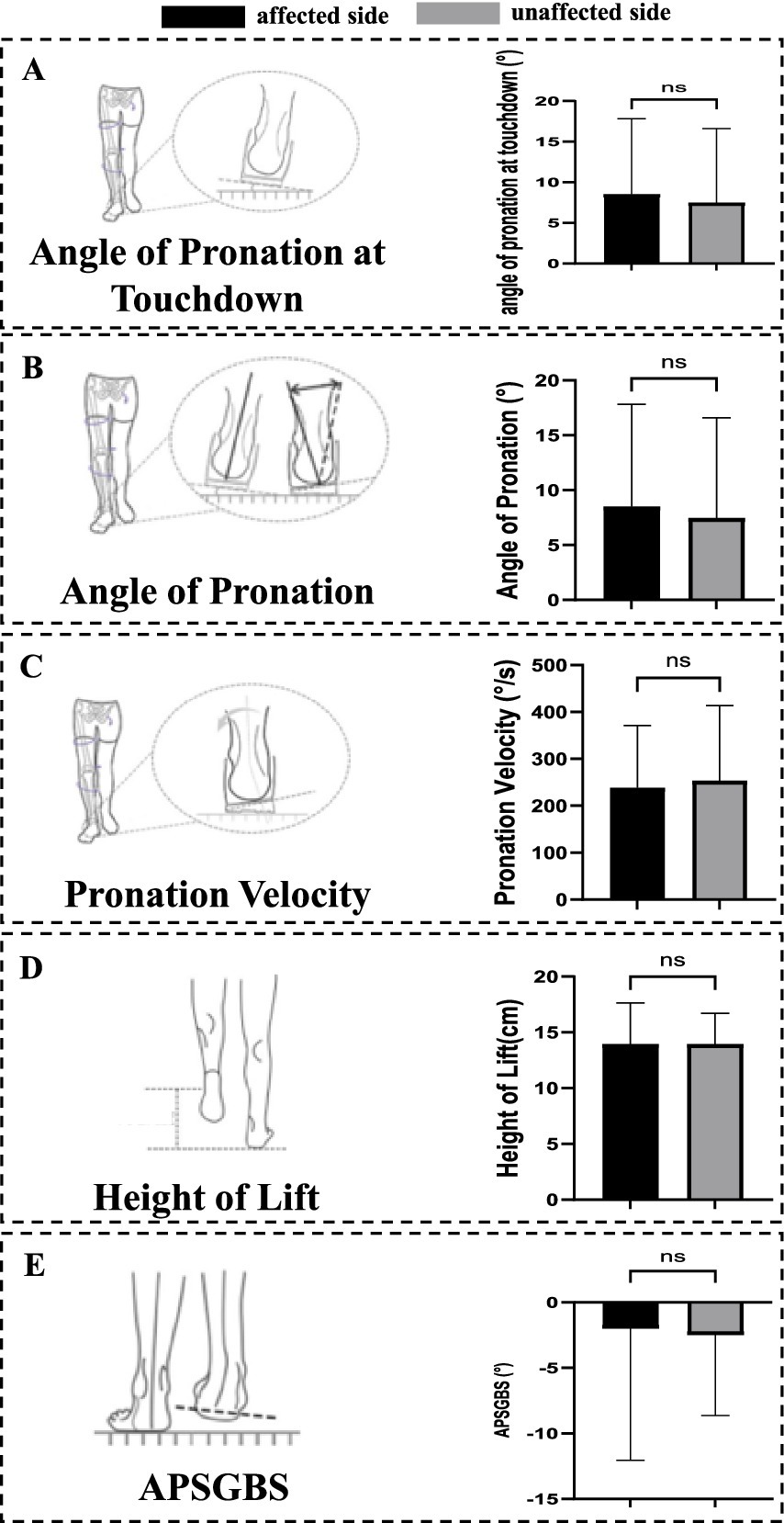 Panels A to E present bar graphs comparing various measurements between affected and unaffected sides. In each graph, black bars show data for the affected side, and gray bars for the unaffected side. No significant differences (ns) are noted in all comparisons. Panel A: Angle of pronation at touchdown. Panel B: Angle of pronation. Panel C: Pronation velocity. Panel D: Height of lift. Panel E: APSGBS measurement. Diagrams of foot positions accompany each graph.
