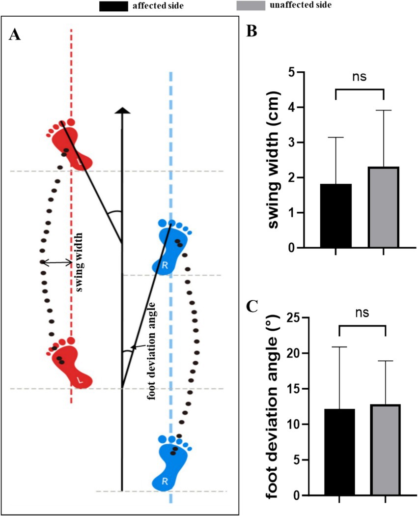 Diagram with three panels. Panel A illustrates foot swing width and deviation angle, showing red and blue footprints with trajectories. Panels B and C are bar graphs comparing affected and unaffected sides. Panel B displays swing width in centimeters, and Panel C shows foot deviation angle in degrees. Both graphs indicate no significant difference (ns) between sides. Black bars indicate affected side and gray bars represent unaffected side.