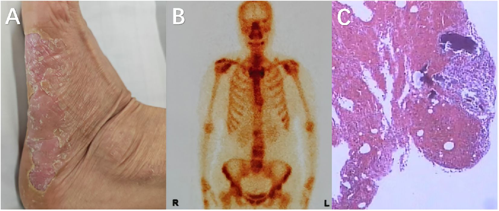 Panel A shows a close-up of a foot with scaly, peeling skin. Panel B is a skeletal scan image highlighting the spine and pelvic area. Panel C displays a microscopic view of tissue, with irregular patterns in purple and pink hues.