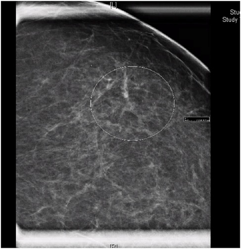 Mammogram image showing dense breast tissue with a circled area of interest in the center. The examination is performed to assess possible abnormalities, with the marked area indicating a region for closer evaluation.