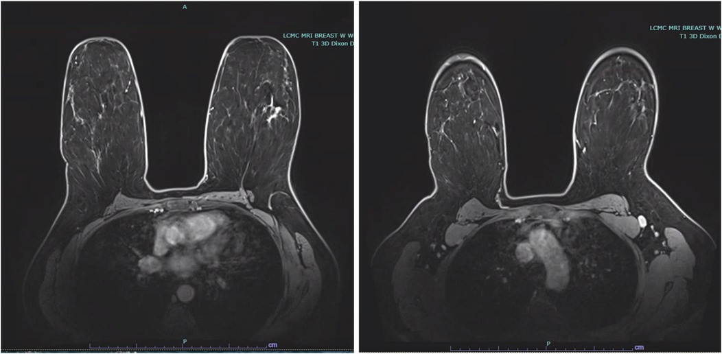 MRI scans of breast tissue displayed side by side. The left image shows enhanced details of the tissue structure, while the right image presents a slightly different view with darker contrast. Both scans are labeled as MRI breast images with annotations in the upper right corners.