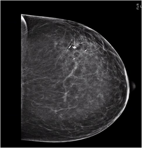 Mammogram image showing the right breast with calcifications identified in the central region. The breast tissue appears dense, with various radiopaque areas scattered throughout.