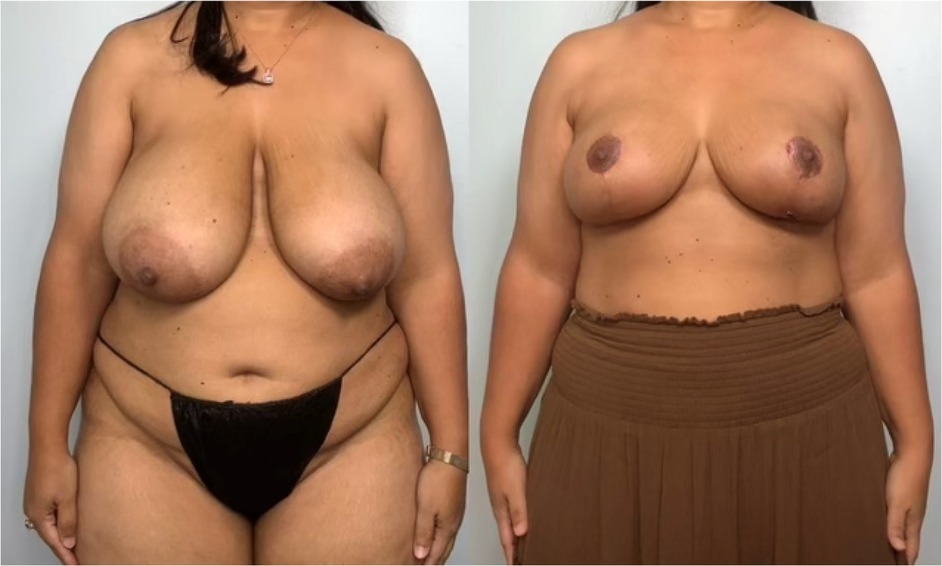 A before and after comparison of the patient following bilateral reduction mastoplasty.