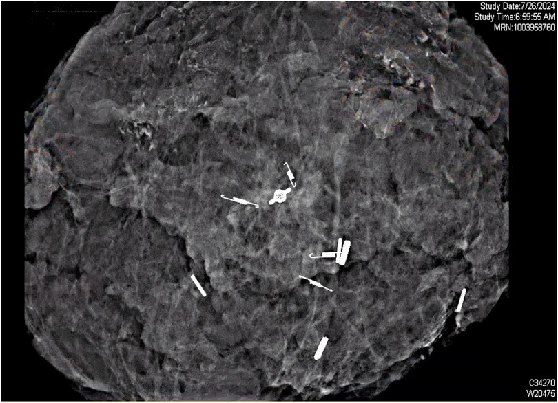 Post-op imaging of the mass removed from the left breast. Four SCOUT reflectors shown at expected locations.