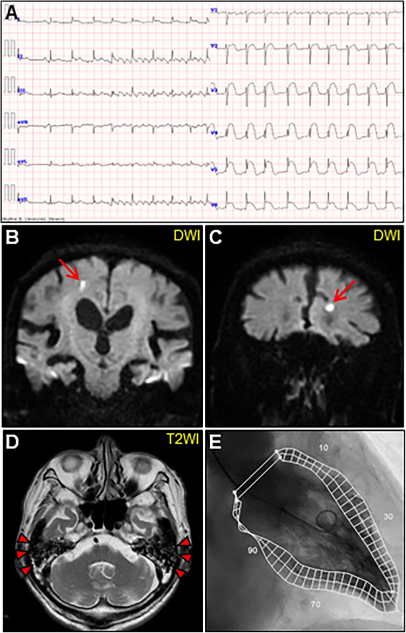 Electrocardiogram (ECG) readings marked as panel A show irregular heartbeats. Panels B and C present Diffusion-Weighted Imaging (DWI) brain scans with red arrows indicating potential abnormalities. Panel D shows a T2-weighted MRI of the brain with red markers on both sides. Panel E features a medical illustration with numerical values and grid lines on an anatomical structure.
