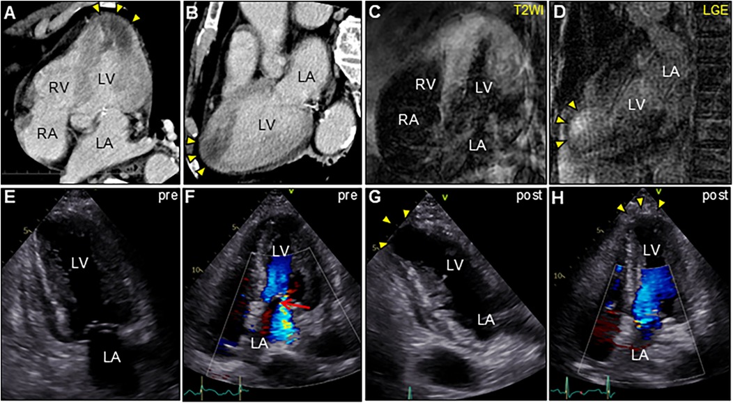 Composite image of cardiac imaging techniques. Panels A-D show scans with labels: RV, LV, RA, LA. Arrowheads point to specific areas. Panels E-H depict echocardiographic images with color flow indicating blood movement. Labels indicate LV and LA, with some panels marked \