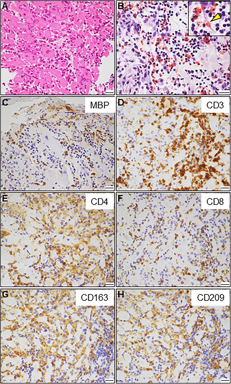 Histological analysis of tissue samples with different staining techniques. Image A shows a hematoxylin and eosin stain with pink and purple hues. Image B includes a detailed view with a yellow arrowhead. Images C to H display immunostaining for MBP, CD3, CD4, CD8, CD163, and CD209, respectively, illustrating varying degrees of brown staining intensity against a purple-blue background, indicating different cellular markers.