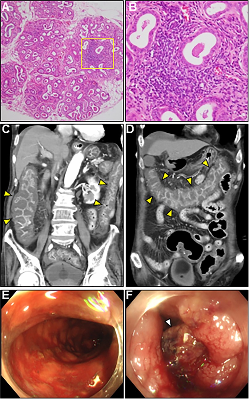 Panel A shows a histological section with glandular structures. Panel B is a magnified view of A, highlighting cellular detail. Panels C and D are CT scans displaying abdominal areas with yellow arrowheads indicating specific features. Panels E and F are endoscopic images; E shows an internal view of a colon segment, while F highlights a mass with a white arrowhead.