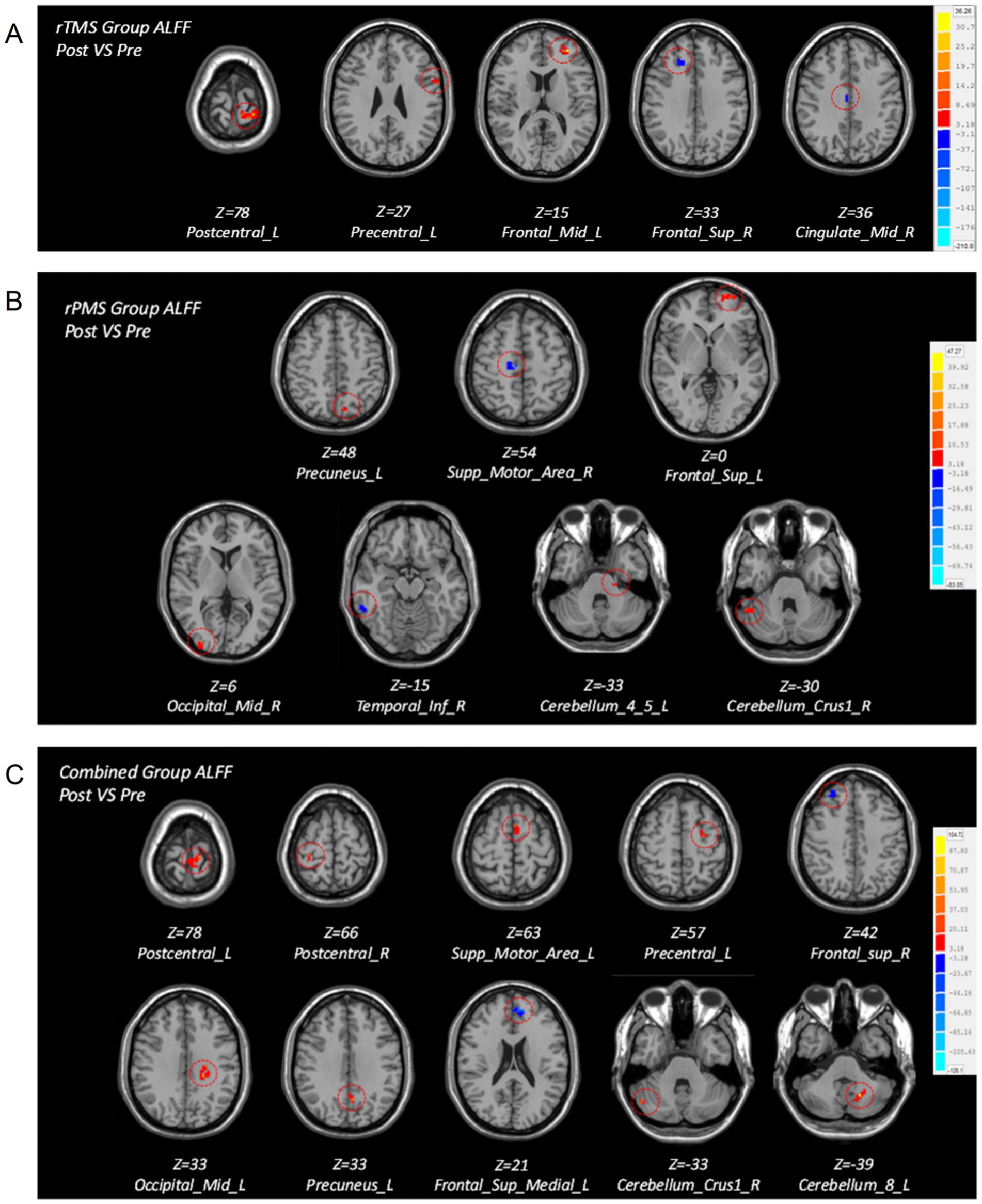 Brain MRI images showing ALFF results for three different groups: A) rTMS Group, B) rPMS Group, and C) Combined Group. Each section displays multiple axial brain slices with highlighted regions in red and blue, indicating changes in activation post vs. pre. The images include Z-scores and labels such as Postcentral_L and Frontal_Sup_R. A color scale bar on the right shows activation intensity from negative to positive values.