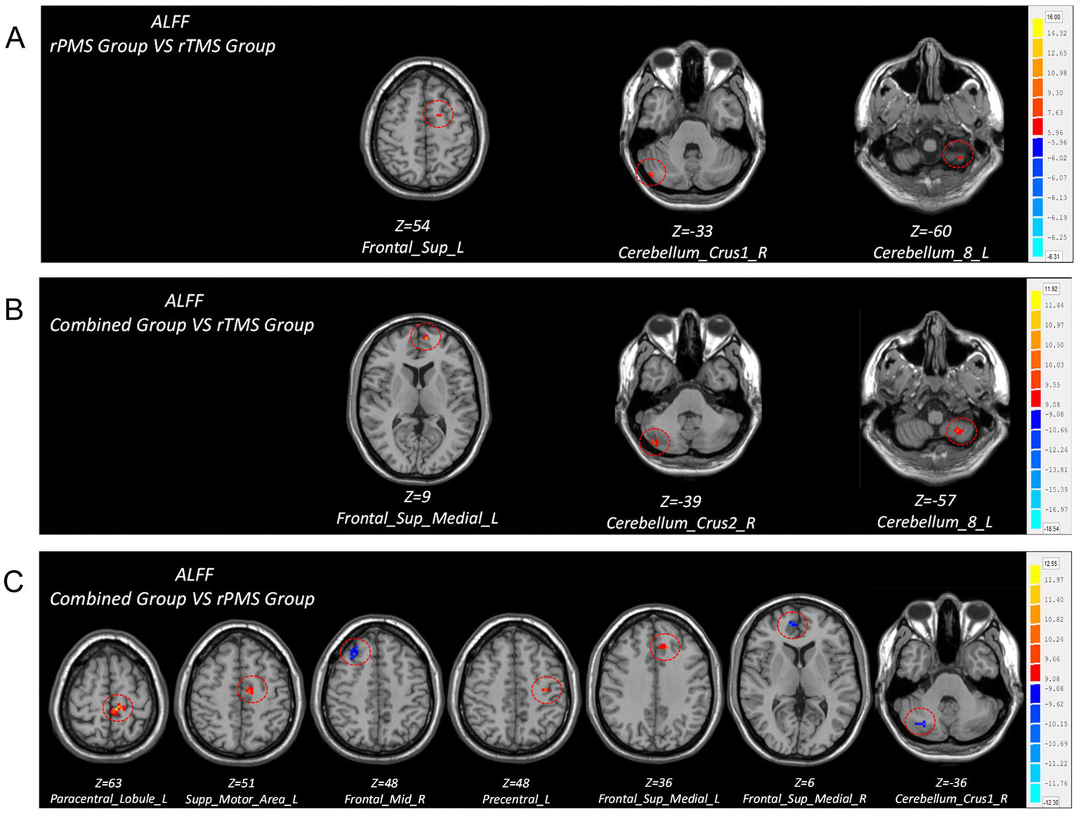 Brain imaging comparison charts in three panels labeled A, B, and C. Panel A shows differences between rPMS and rTMS groups with highlighted frontal and cerebellum regions. Panel B compares combined and rTMS groups, highlighting similar regions. Panel C contrasts combined and rPMS groups, showing multiple frontal and cerebellum areas. Each panel includes overlayed color scales.