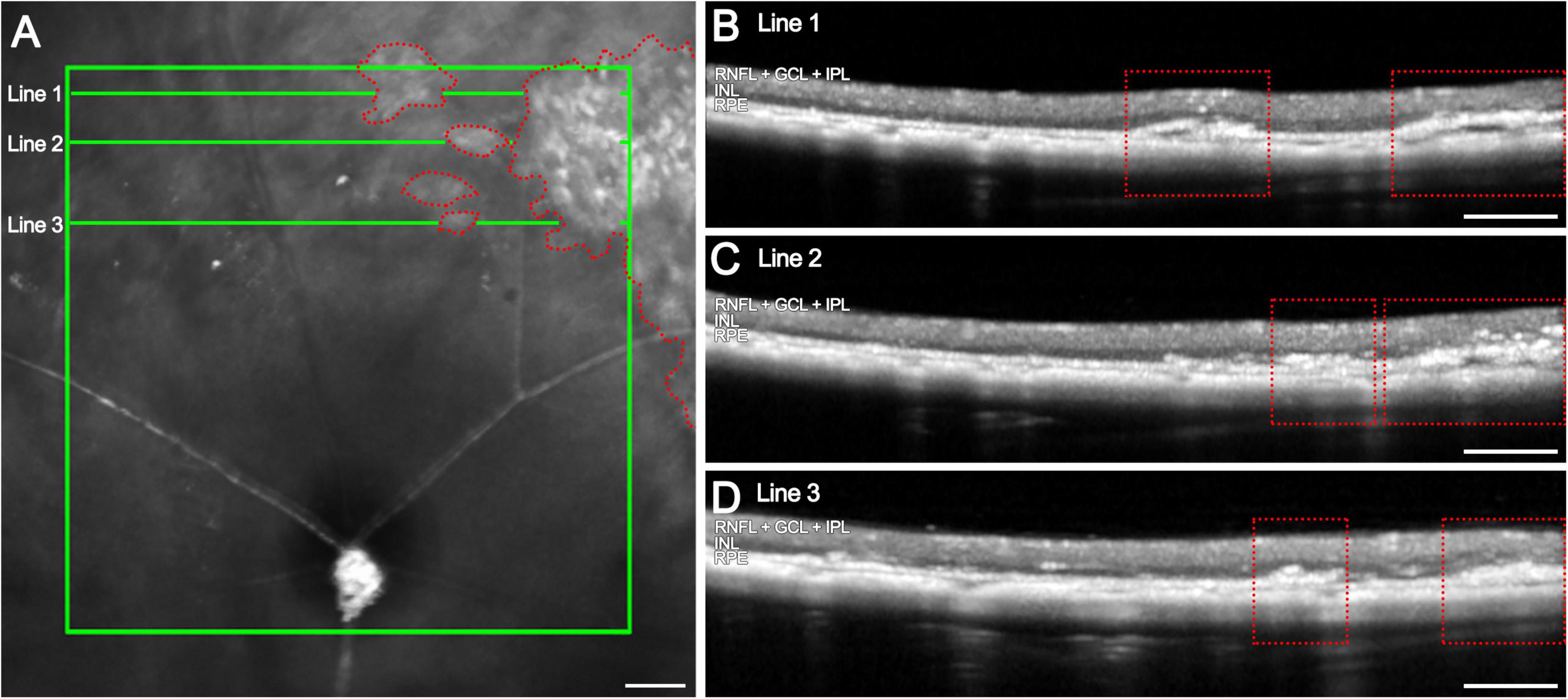 Composite image featuring a retinal OCT scan with three transverse line sections marked as Line 1, Line 2, and Line 3 within a green box in panel A. Panels B, C, and D show detailed cross-sectional views corresponding to each line, highlighting retinal layers such as RNFL, GCL, IPL, INL, and RPE. Dotted red boxes in each sectional view indicate areas of interest. Scale bars are present for reference.