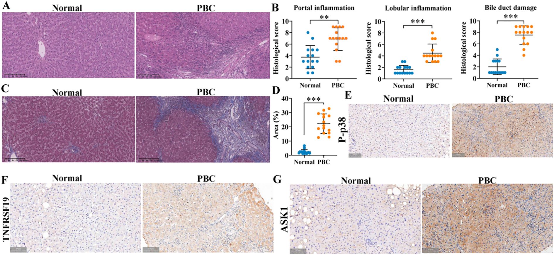 Histological and immunohistochemical comparisons between normal and Primary Biliary Cholangitis (PBC) liver tissues. Panels A and C show stained tissue samples, highlighting differences in structure. Panel B presents graphs comparing histological scores for inflammation and bile duct damage in normal versus PBC tissues. Panel D shows a graph of area percentages, contrasting normal and PBC conditions. Panels E, F, and G display immunohistochemical staining for proteins P-p38, TNFRSF19, and ASK1, with visible differences in expression levels between normal and PBC samples.