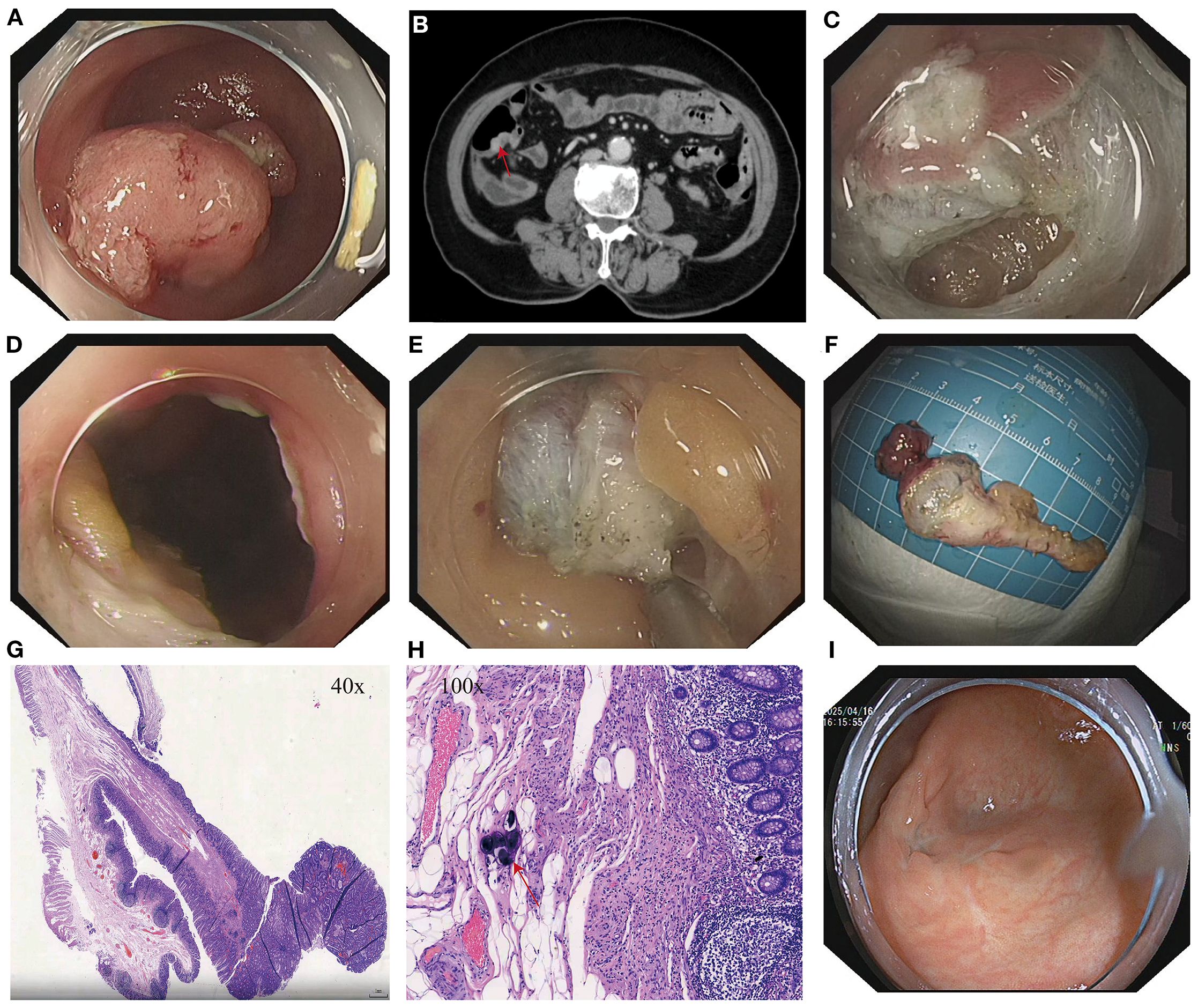 A multi-panel medical illustration showing: A. Colonoscopic view of a large polypoid lesion. B. CT scan highlighting a lesion in the colon with a red arrow. C-E. Sequence of polyp removal process. F. Polyp specimen on a measuring grid. G. Histological section of the polyp at 40x magnification. H. Detailed cellular view at 100x magnification. I. Post-removal colonoscopic view showing healed tissue.
