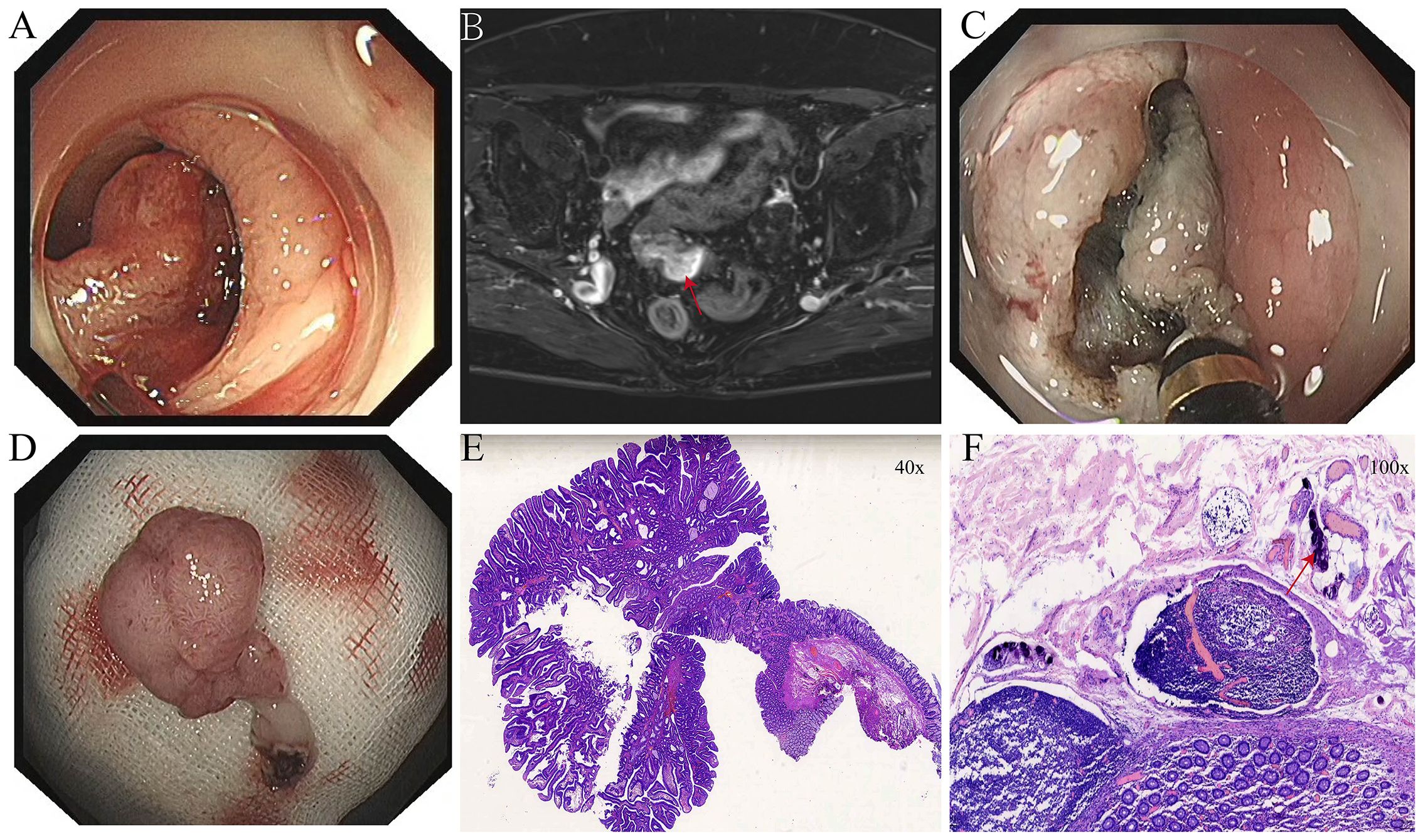 A set of six medical images shown in a labeled sequence. Image A presents an endoscopic view of an intestinal lumen with a large, irregular mass. Image B is an MRI scan showing a highlighted area with a red arrow, indicating an abnormality in the pelvic region. Image C depicts another endoscopic view of the intestinal mass with a tool. Image D shows the extracted mass placed on gauze. Image E is a histopathology slide at forty times magnification showing tissue structure. Image F shows a higher magnification histopathology slide at one hundred times, with arrows indicating specific cellular details.