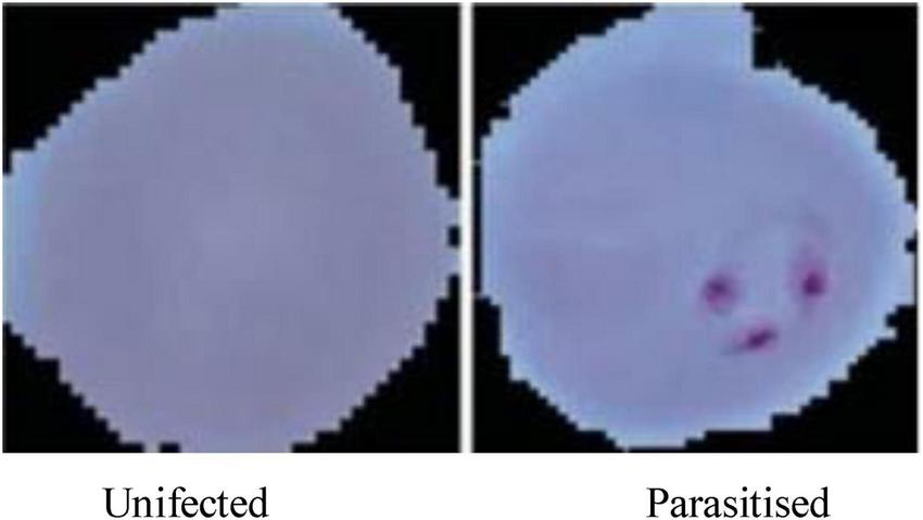 Two side-by-side micrographs depict red blood cells. The left shows an uninfected cell, appearing uniformly light-colored. The right shows a parasitized cell with dark spots indicating infection.
