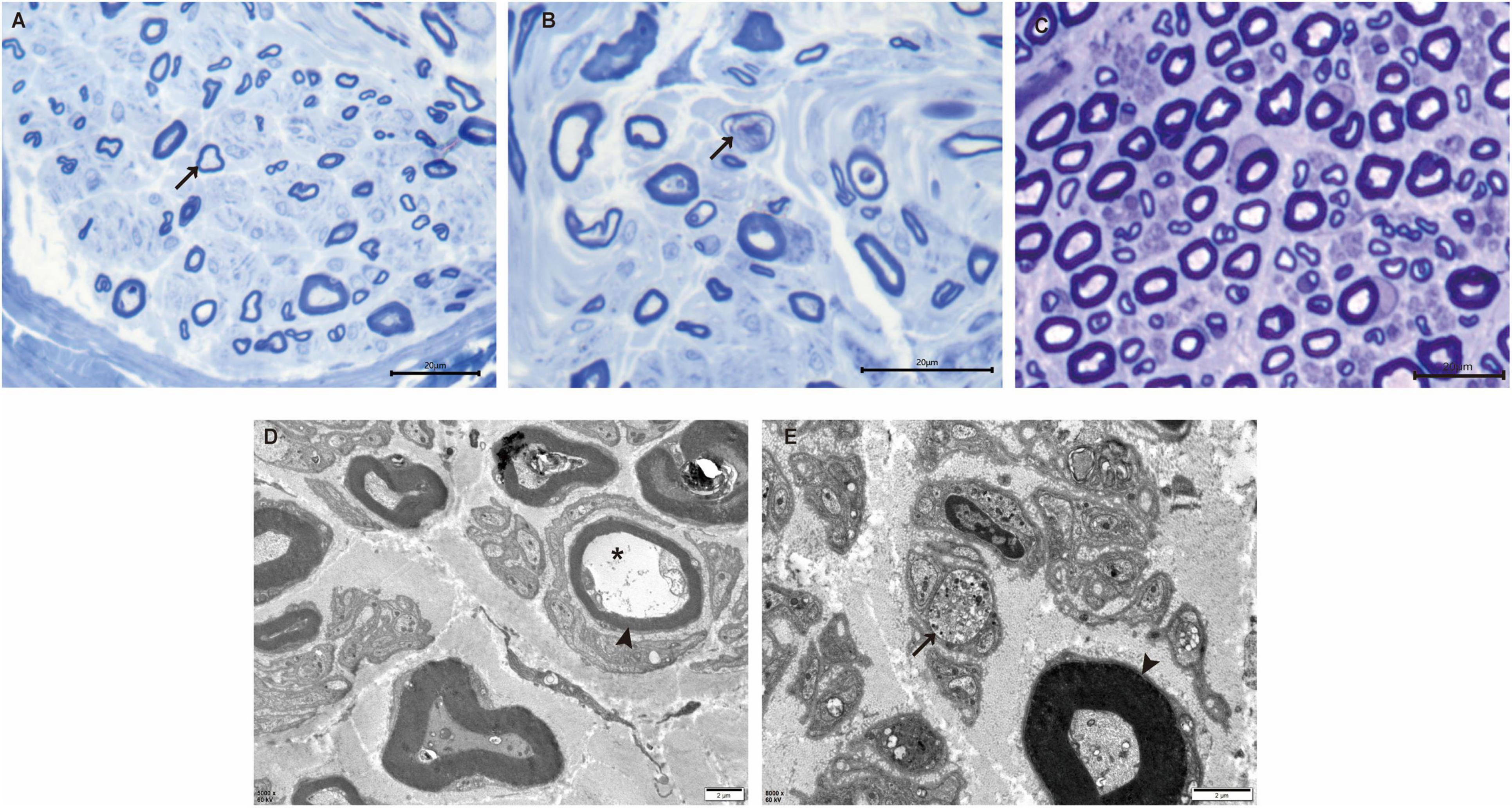 Histopathology of the proband’s sural nerve showing reduced myelinated fibers, thin myelin sheaths, axonal degeneration, abnormal mitochondria under light and electron microscopy, and comparison with a control.